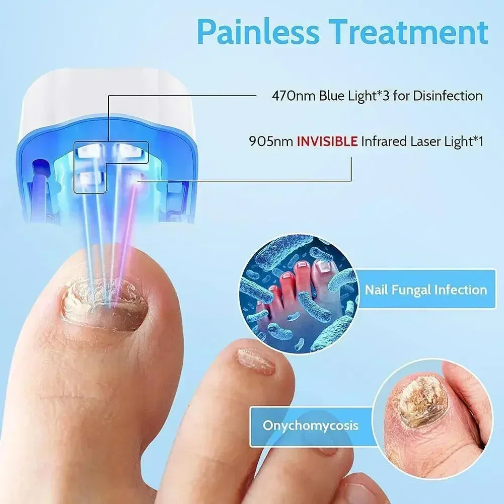 Nail Fungus Cleaning Laser Device - Expert Revolutionary High-Efficiency Light Therapy Device For Toenail Diseases