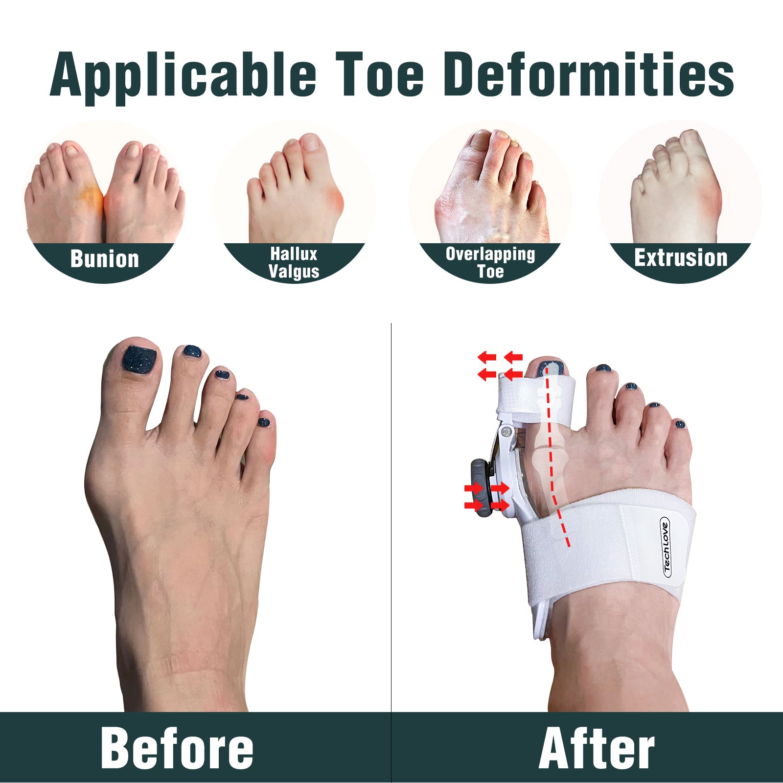 Premium Grade Bunion Toe Splint Straightener Corrector