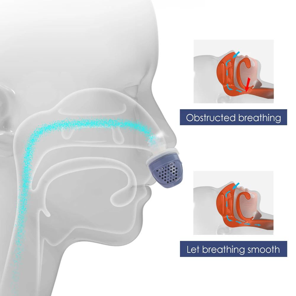 Micro Electric Anti Snoring